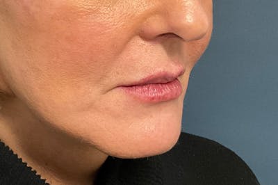 Facial Fillers Before & After Gallery - Patient 151442 - Image 4