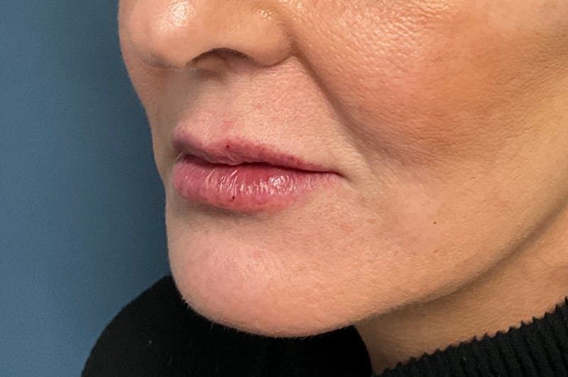 Facial Fillers Before & After Gallery - Patient 151442 - Image 6