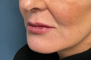 Facial Fillers Before & After Gallery - Patient 151442 - Image 6
