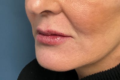 Facial Fillers Before & After Gallery - Patient 151442 - Image 6