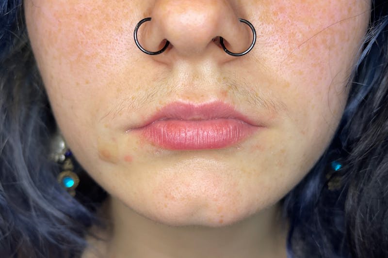 Facial Fillers Before & After Gallery - Patient 231952 - Image 1