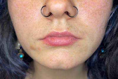 Facial Fillers Before & After Gallery - Patient 231952 - Image 1