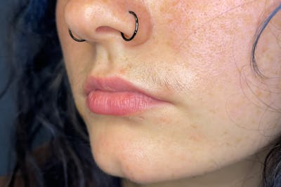 Facial Fillers Before & After Gallery - Patient 231952 - Image 5