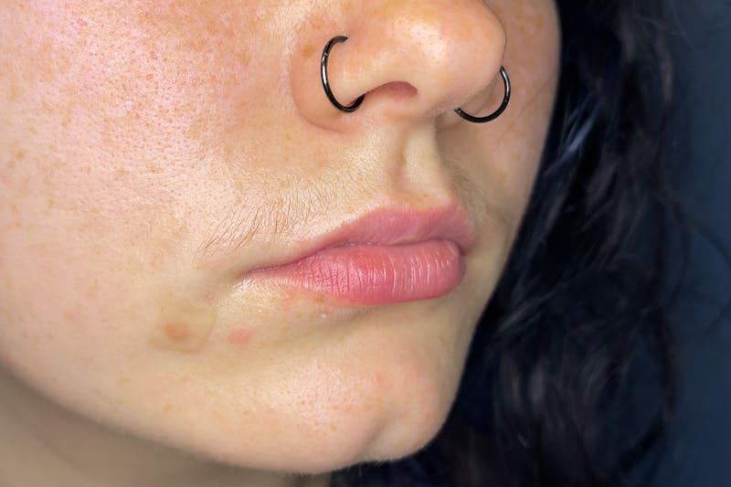 Facial Fillers Before & After Gallery - Patient 231952 - Image 3