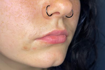 Facial Fillers Before & After Gallery - Patient 231952 - Image 3