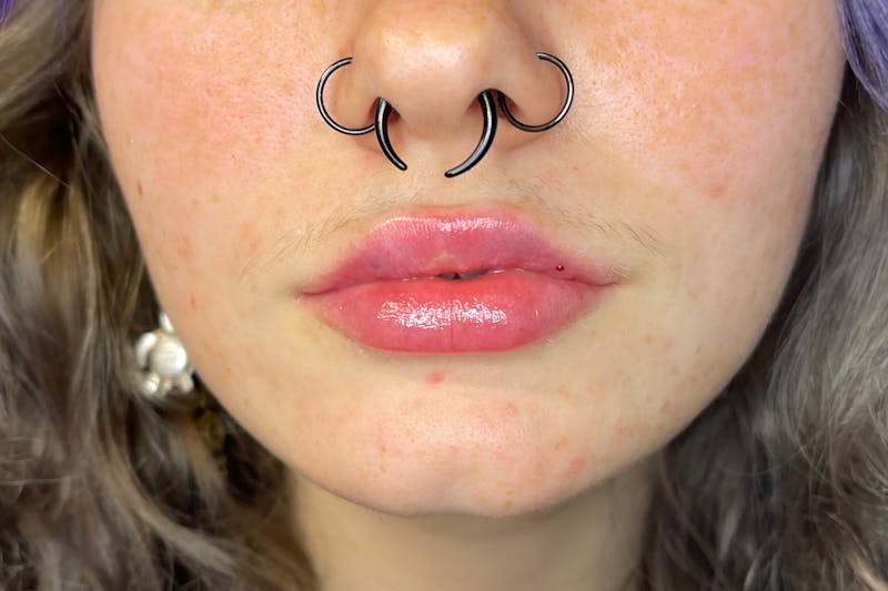 Facial Fillers Before & After Gallery - Patient 231952 - Image 2