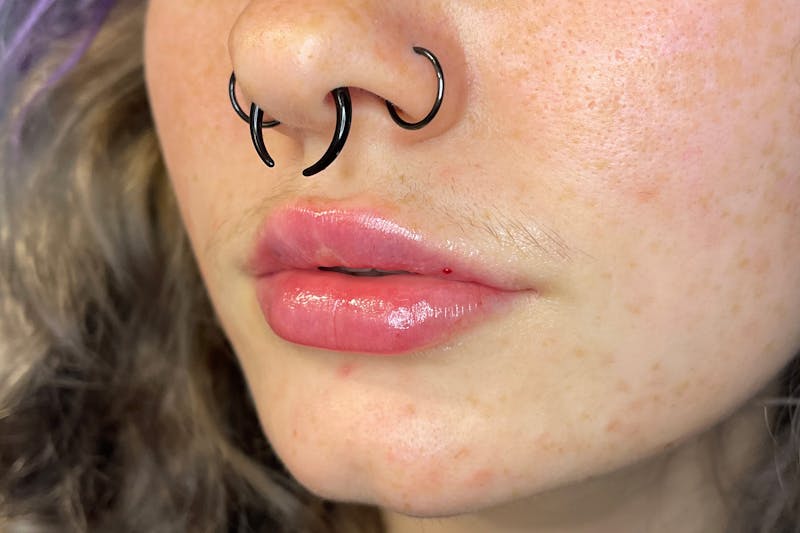 Facial Fillers Before & After Gallery - Patient 231952 - Image 6