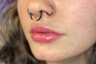 Facial Fillers Before & After Gallery - Patient 231952 - Image 6