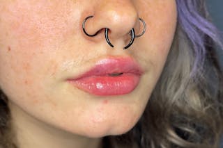 Facial Fillers Before & After Gallery - Patient 231952 - Image 4