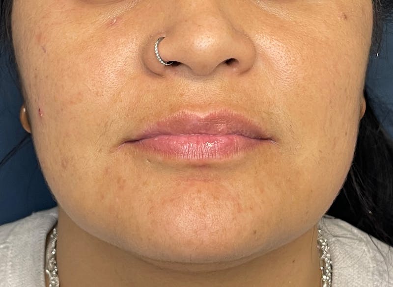 Facial Fillers Before & After Gallery - Patient 158405 - Image 1