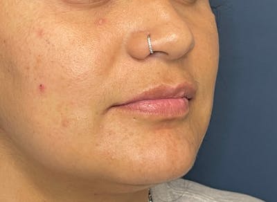 Facial Fillers Before & After Gallery - Patient 158405 - Image 3