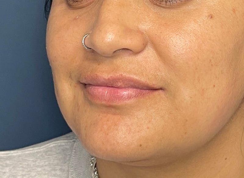 Facial Fillers Before & After Gallery - Patient 158405 - Image 5