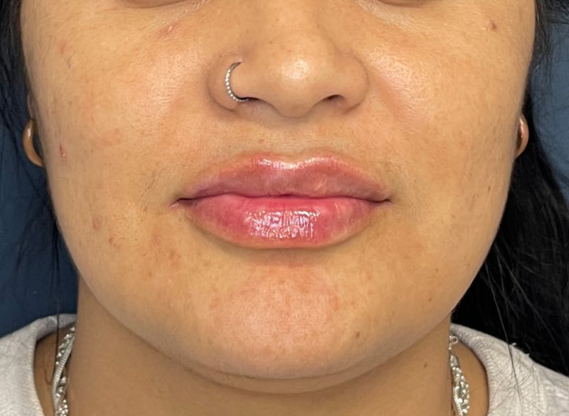 Facial Fillers Before & After Gallery - Patient 158405 - Image 2