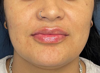 Facial Fillers Before & After Gallery - Patient 158405 - Image 2