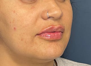 Facial Fillers Before & After Gallery - Patient 158405 - Image 4