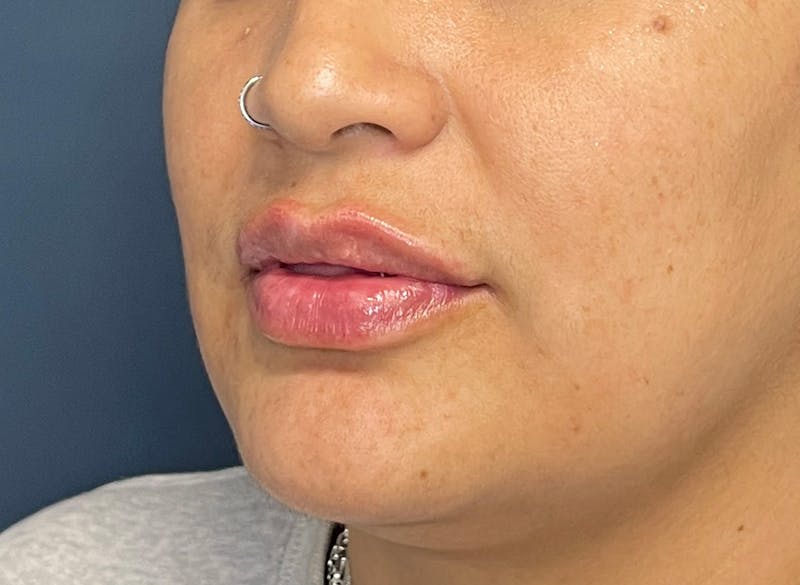 Facial Fillers Before & After Gallery - Patient 158405 - Image 6