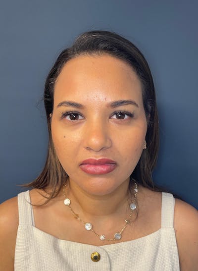 Facial Fillers Before & After Gallery - Patient 344407 - Image 2