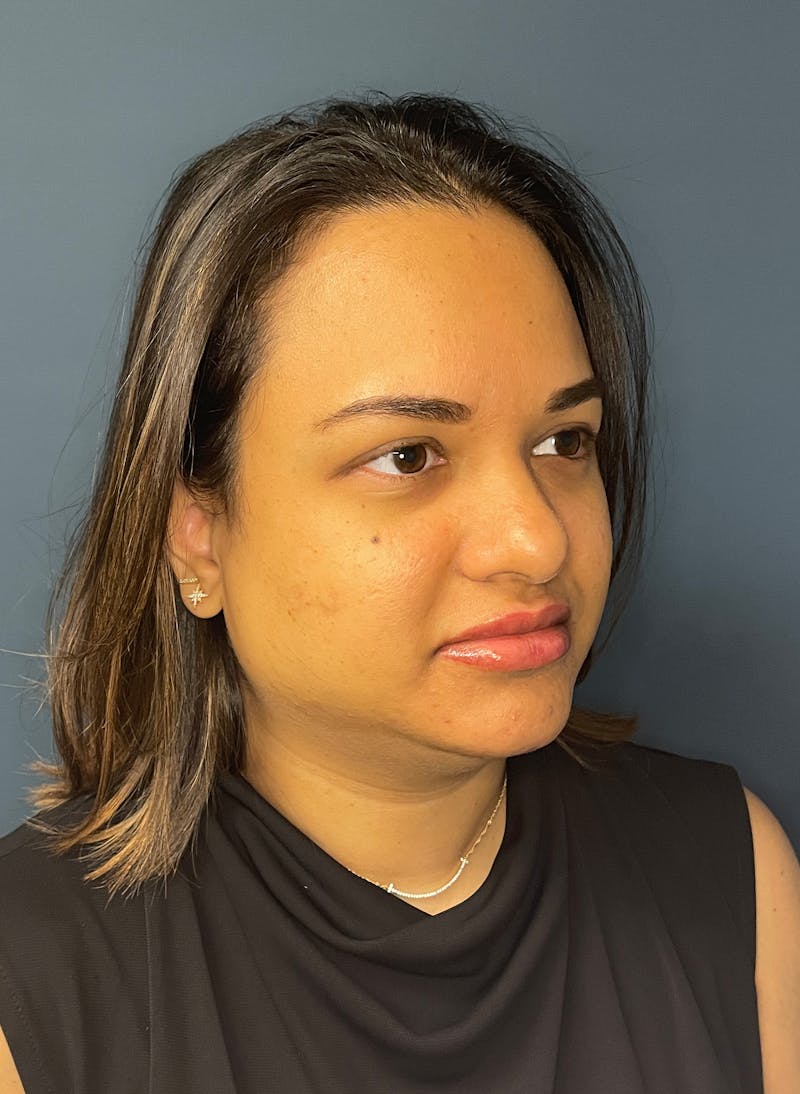 Facial Fillers Before & After Gallery - Patient 344407 - Image 3