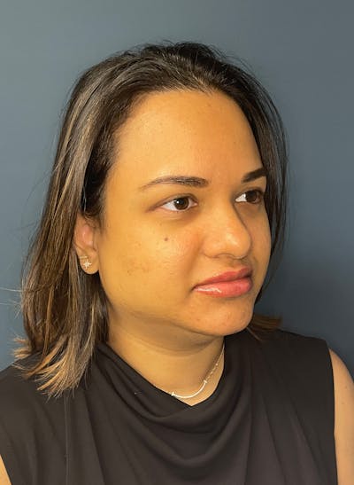 Facial Fillers Before & After Gallery - Patient 344407 - Image 3