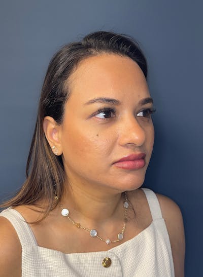 Facial Fillers Before & After Gallery - Patient 344407 - Image 4
