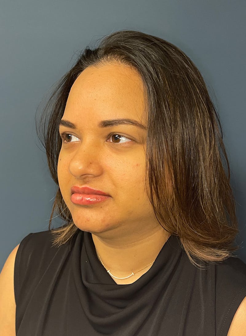 Facial Fillers Before & After Gallery - Patient 344407 - Image 5