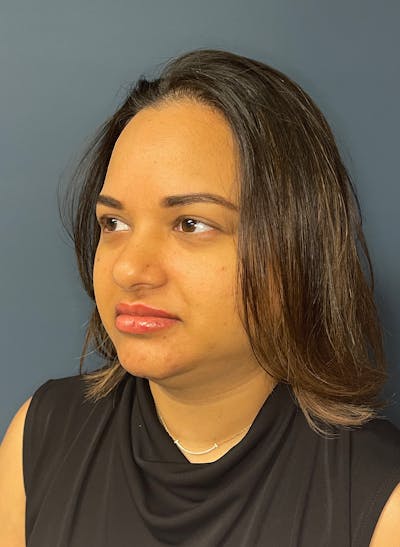 Facial Fillers Before & After Gallery - Patient 344407 - Image 5