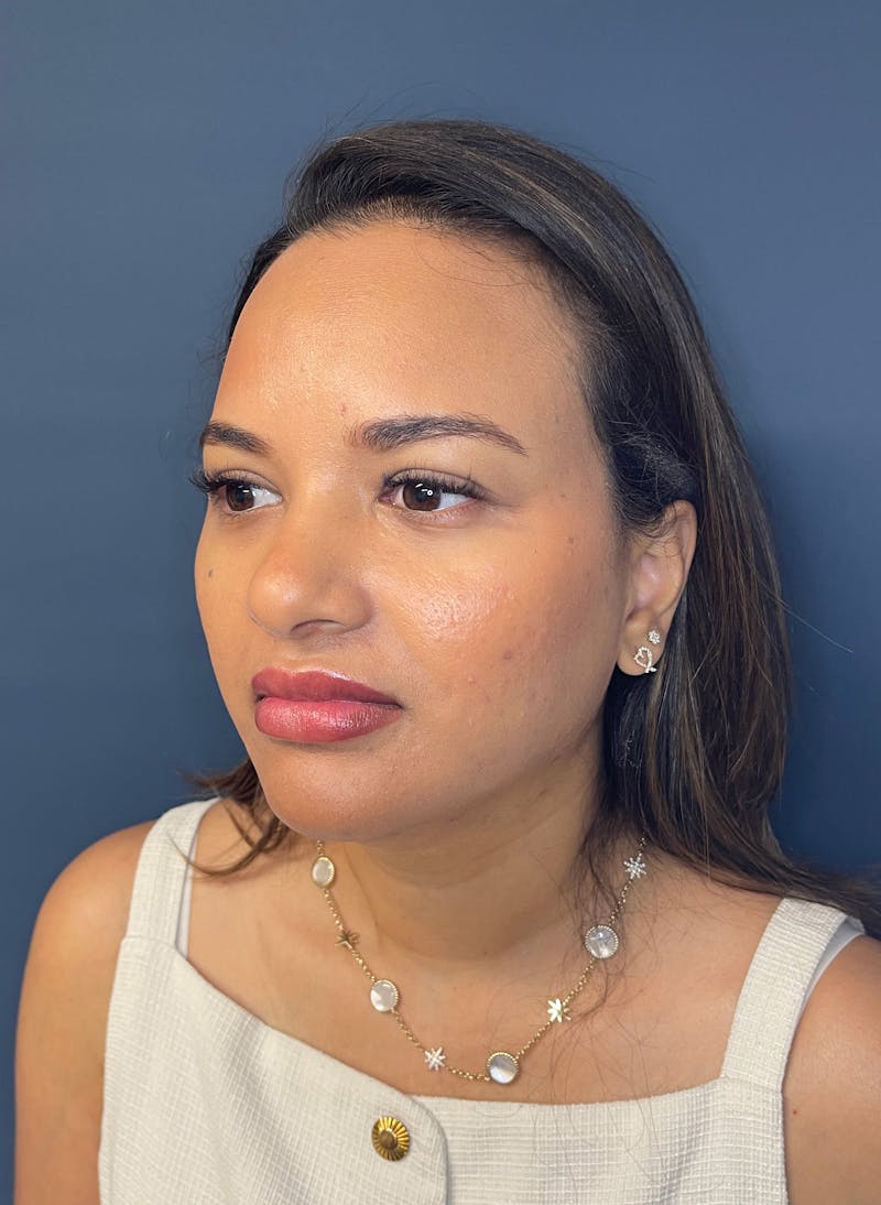 Facial Fillers Before & After Gallery - Patient 344407 - Image 6