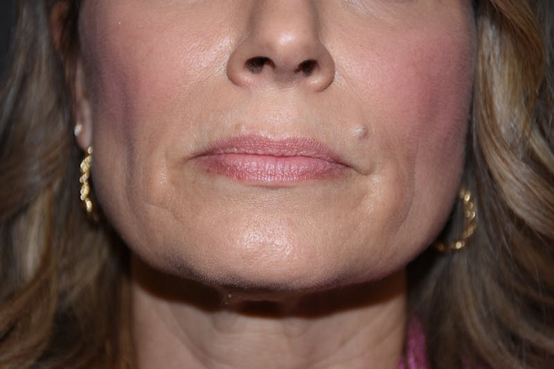 Facial Fillers Before & After Gallery - Patient 533893 - Image 1