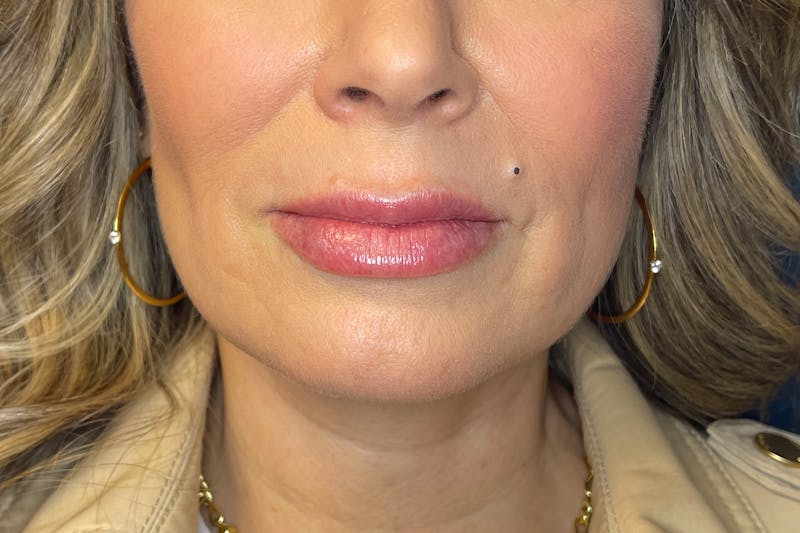 Facial Fillers Before & After Gallery - Patient 533893 - Image 2