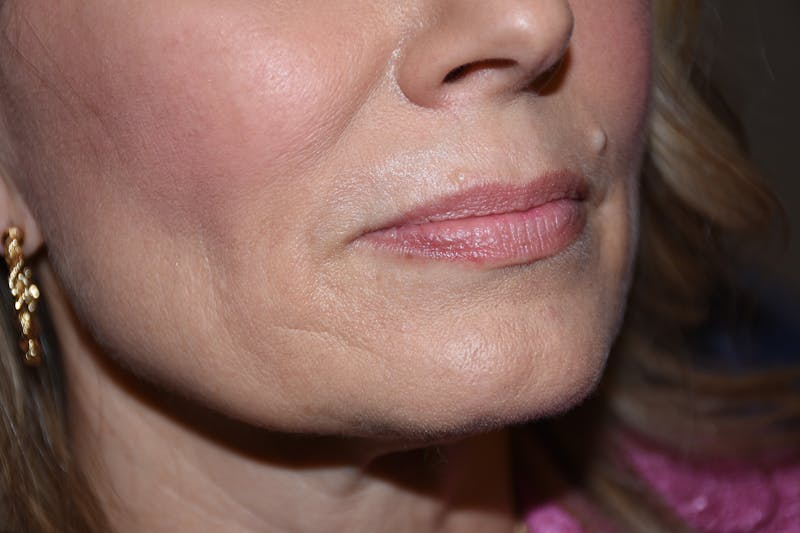 Facial Fillers Before & After Gallery - Patient 533893 - Image 3