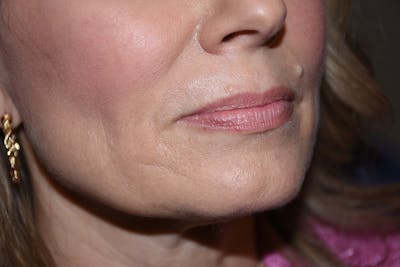 Facial Fillers Before & After Gallery - Patient 533893 - Image 3