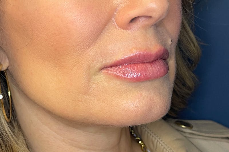 Facial Fillers Before & After Gallery - Patient 533893 - Image 4