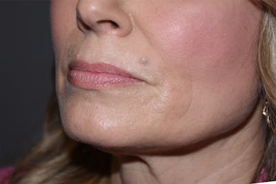 Facial Fillers Before & After Gallery - Patient 533893 - Image 5