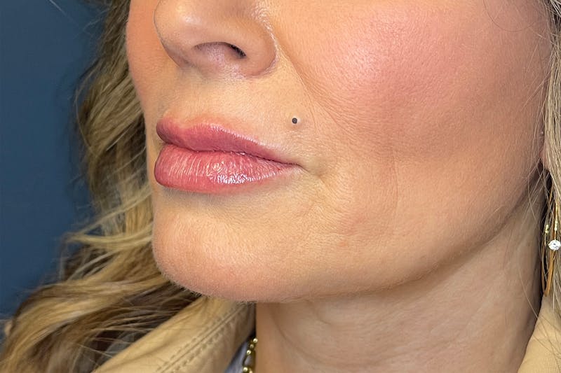 Facial Fillers Before & After Gallery - Patient 533893 - Image 6