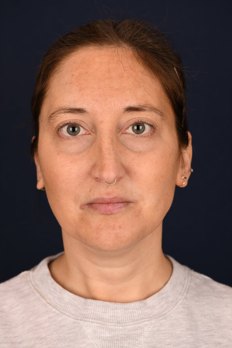 Facial Fillers Before & After Gallery - Patient 420717 - Image 1