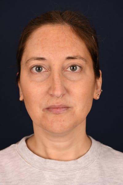 Facial Fillers Before & After Gallery - Patient 420717 - Image 1