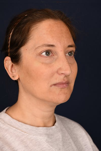 Facial Fillers Before & After Gallery - Patient 420717 - Image 3