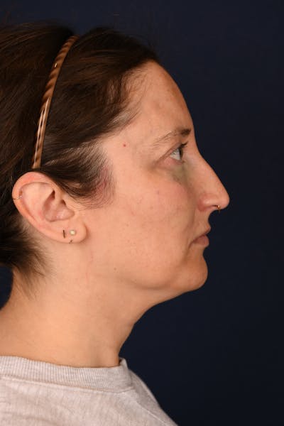 Facial Fillers Before & After Gallery - Patient 420717 - Image 6