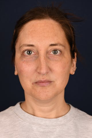 Facial Fillers Before & After Gallery - Patient 420717 - Image 2