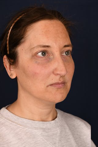 Facial Fillers Before & After Gallery - Patient 420717 - Image 4