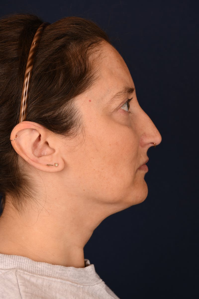 Facial Fillers Before & After Gallery - Patient 420717 - Image 5