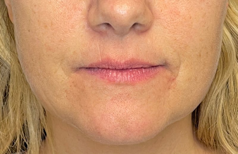 Facial Fillers Before & After Gallery - Patient 348858 - Image 1