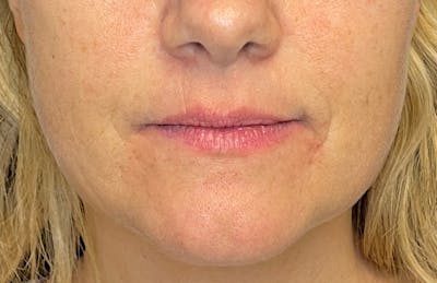 Facial Fillers Before & After Gallery - Patient 348858 - Image 1