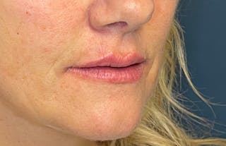 Facial Fillers Before & After Gallery - Patient 348858 - Image 4