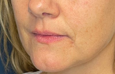 Facial Fillers Before & After Gallery - Patient 348858 - Image 5