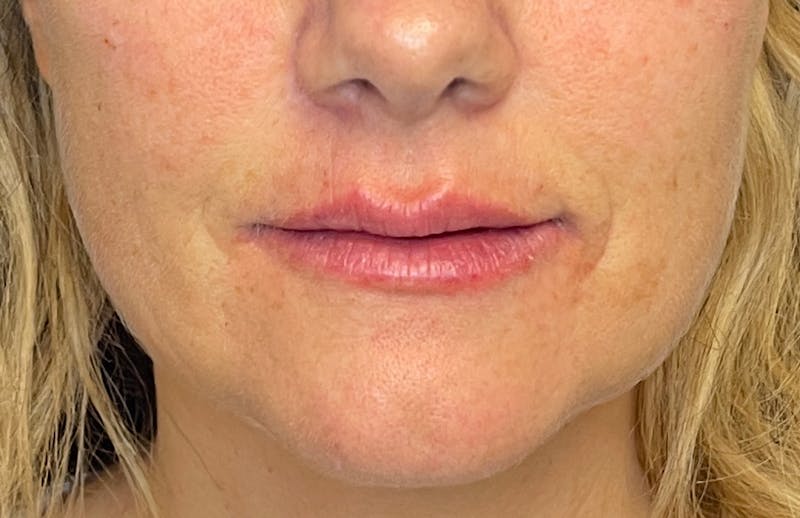 Facial Fillers Before & After Gallery - Patient 348858 - Image 2