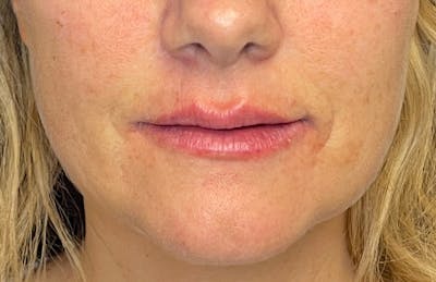 Facial Fillers Before & After Gallery - Patient 348858 - Image 2