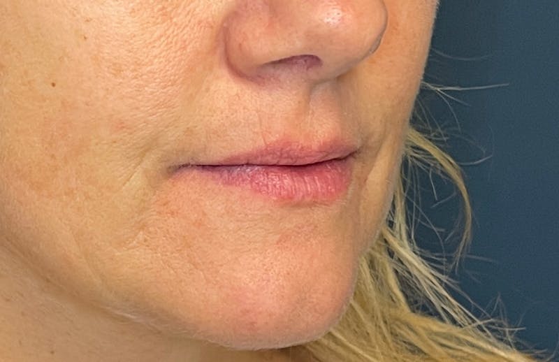 Facial Fillers Before & After Gallery - Patient 348858 - Image 3