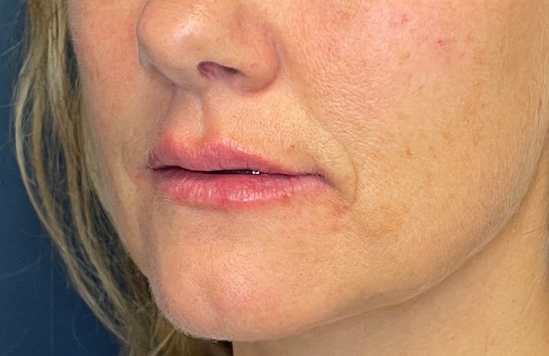 Facial Fillers Before & After Gallery - Patient 348858 - Image 6