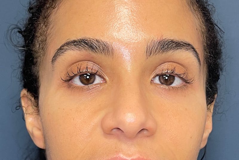 Facial Fillers Before & After Gallery - Patient 843575 - Image 1